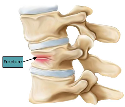 Spinal Compression Fracture  Top Orthopedic in Boca Raton